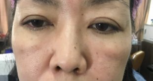 Before And After Using 9D 7 . Thread Brow Sculpting Technology