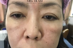 Before And After Using 9D 9 . Thread Brow Sculpting Technology