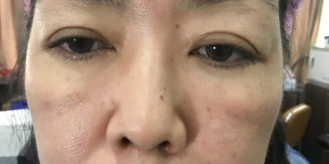 Before And After Using 9D 4 . Thread Brow Sculpting Technology