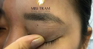 Before and After Eyebrow Removal Technology Leaves No Scars With Yag Laser Technology 1