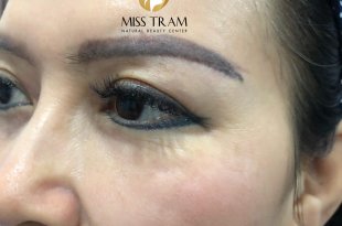 Before And After Scar Treatment - Eyebrows Discoloration By Spraying Powder 16