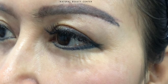 Before And After Scar Treatment - Eyebrows Discoloration By Spraying Powder 4