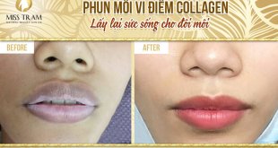 Before And After 4 . High-Tech Micro-Point Lip Spray
