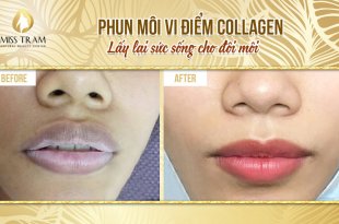 Before And After 3 . High-Tech Micro-Point Lip Spray