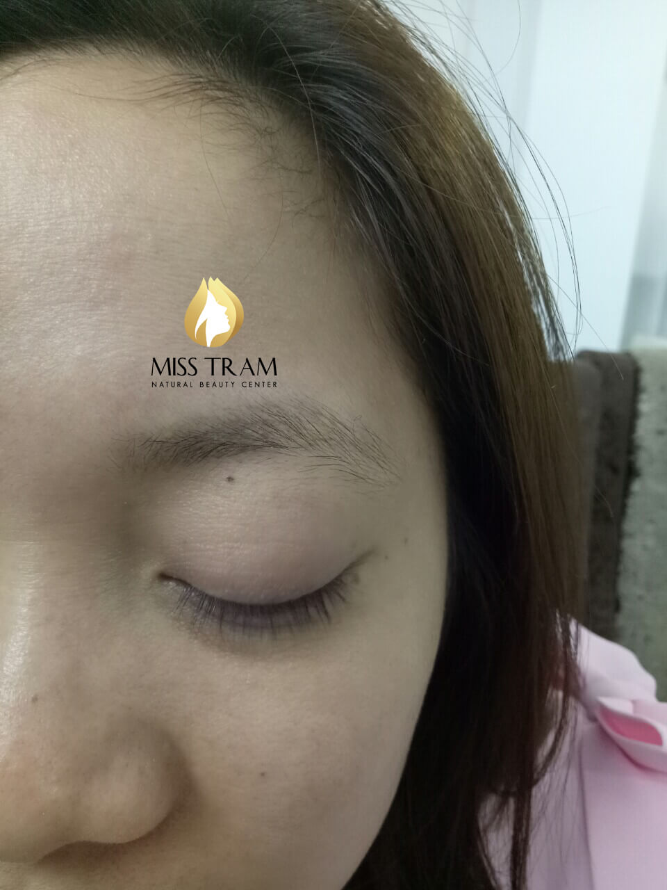 Trước và Sau Công Nghệ Xóa Mày Không Để Lại Sẹo Bằng Công Nghệ Laser Yag 8