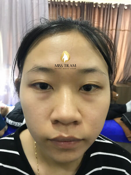 Before And After Using 9D 5 . Thread Brow Sculpting Technology