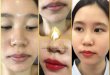 Before And After Spraying Queen Lips For Young Female Customers 6