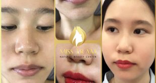 Before And After Spraying Queen Lips For Young Female Customers 4