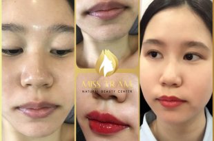 Before And After Spraying Queen Lips For Young Female Customers 14