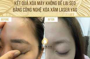 Before And After Using Eyebrow Removal Technology Without Leaving Scars 35