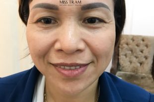Before And After Skin Rejuvenation Results For Customers With Hifu Technology 4