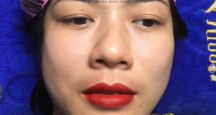 Before And After Using Lip Spray Technology For Customers 22
