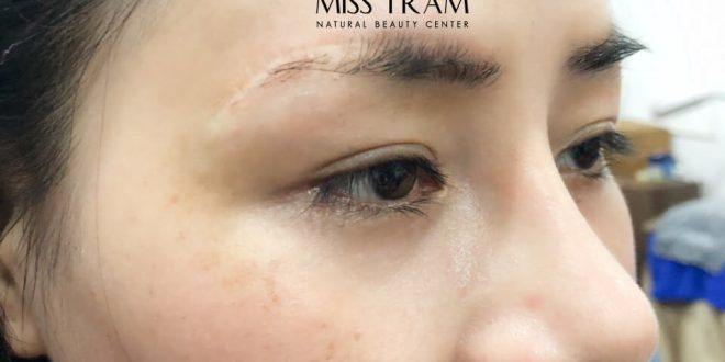 Before And After The Results Of Sculpting Eyebrows To Cover Scars For Customers 4
