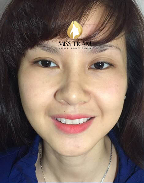 Before & After Lifting Results - Facial Rejuvenation With Hifu Technology 4