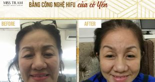 Before And After Wrinkle Removal Using Hifu Technology For Customers 22