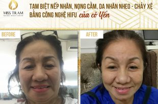 Before And After Wrinkle Removal Using Hifu Technology For Customers 6