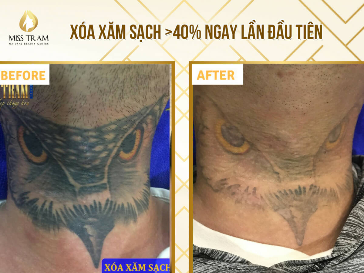 Introducing to you the top most prestigious tattoo removal addresses in Ho Chi Minh City to ensure your tattoo disappears completely.