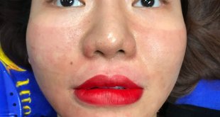 Before And After Results Using Lip Sculpting Method For Women 1