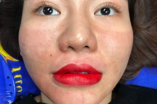 Before And After Results Using Lip Sculpting Method For Women 4