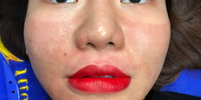 Before And After Results Using Lip Sculpting Method For Women 3