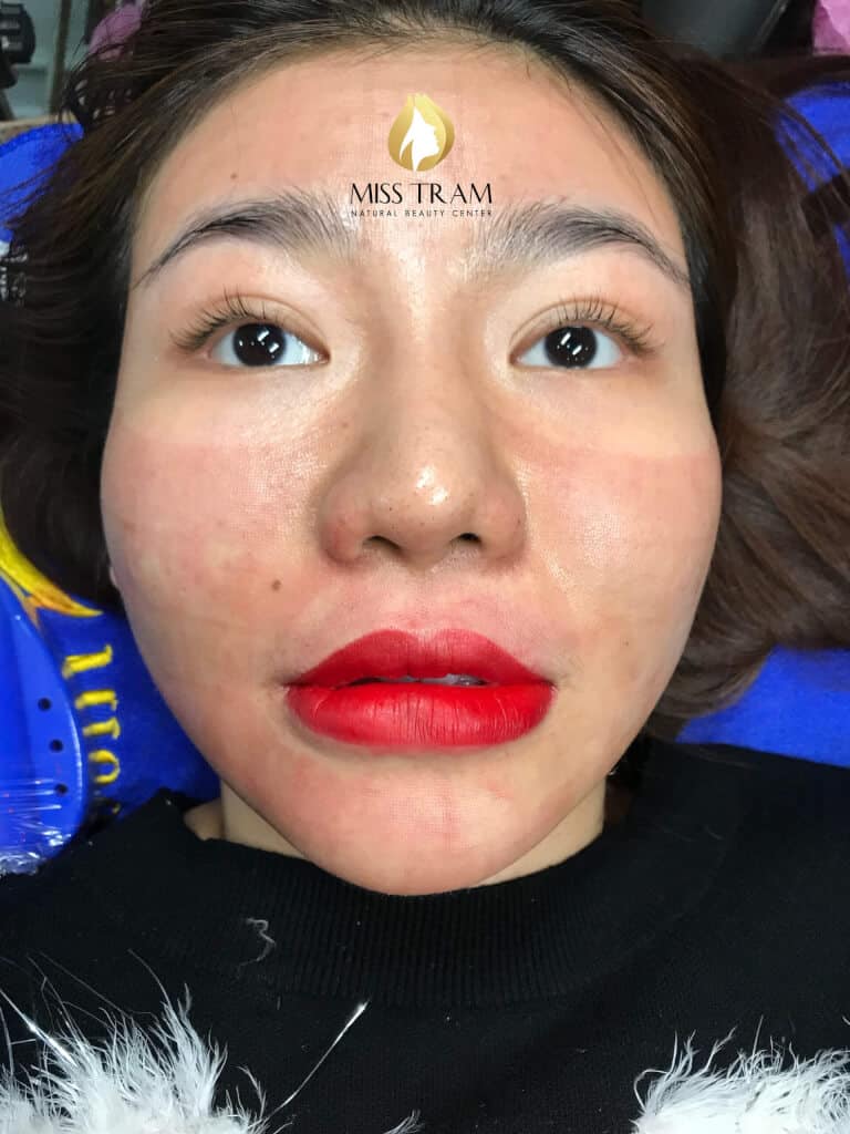 Before And After Results Using Lip Sculpting Method For Women 5