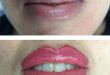 Treatment of Lip Color Too Dark - Irregular - Blurred - Bruise 8