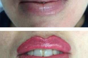 Treatment of Lip Color Too Dark - Irregular - Blurred - Bruise 18