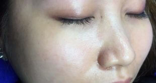 Treatment of Red and Blue Eyebrow Skin After Tattooing 7