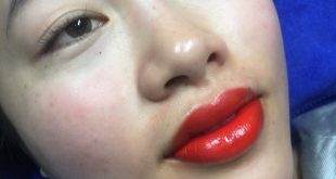 The Secret to Remove Dark Lip Lines With High Technology 100% Leaves No Scars 3