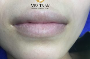 Before And After Queen Lip Sculpture - Actual Customer Photos 45