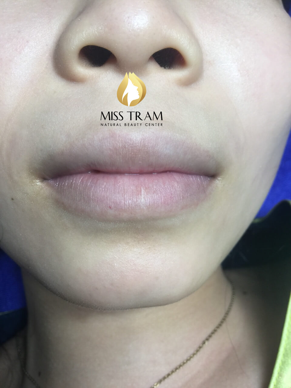Before And After Queen Lip Sculpture - Actual Customer Photos 5