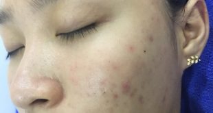 Before And After Acne Treatment With Fractional CO2 Laser Technology 3