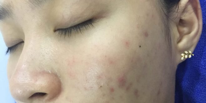 Before And After Acne Treatment With Fractional CO2 Laser Technology 5