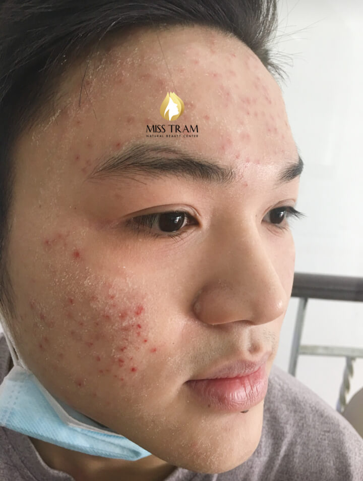 Before And After Acne Treatment With Fractional CO2 Laser Technology For Men 7
