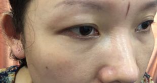 Before And After Treating Old Eyebrows, Shaping New Eyebrows With Sculpting Technology 10