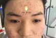 Before And After Acne Treatment With Fractional CO2 Laser Technology For Men 20