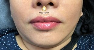 Before And After Performing Queen Collagen Lip Spray Technology 1