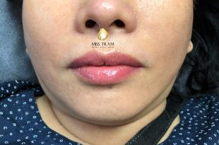 Before And After Performing Queen Collagen Lip Spray Technology 24
