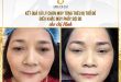 Before And After Treatment of Red Embroidery Eyebrows - 9D Threading Sculpture 8