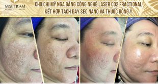 Before And After Acne Treatment - Darkening - Keloid Scars - Skin Resurfacing with Fractional CO2 Laser Technology Combined with Traditional Medicine 47