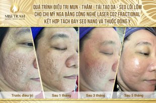Before And After Acne Treatment - Darkening - Keloid Scars - Skin Resurfacing with Fractional CO2 Laser Technology Combined with Traditional Medicine 19
