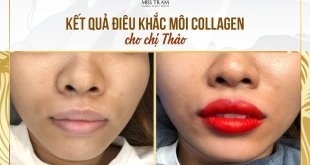 Before And After Deep Treatment And Lip Sculpting Collagen 18