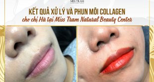 Before And After Treatment And Beauty By Collagen Lip Spray 7