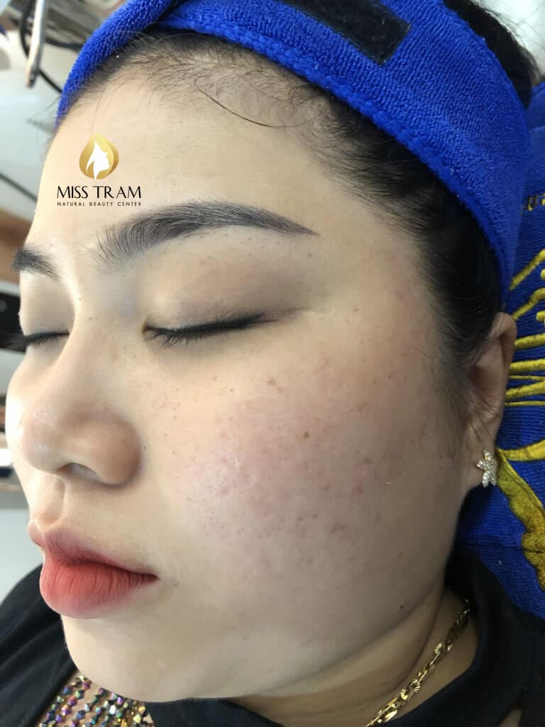 Trước Và Sau 2 Tháng Điều Trị Mụn Ẩn Dưới Da Bằng Công Nghệ Cao Laser CO2 Fractional 12