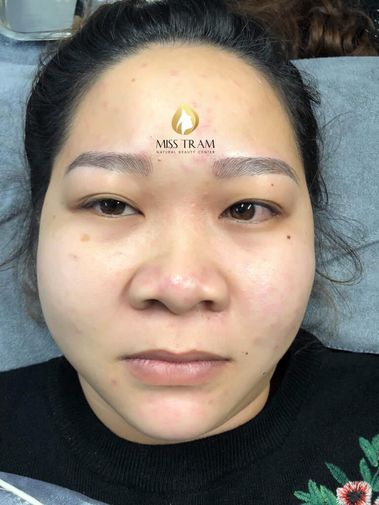 Before And After Using Technology To Sculpt Brow For Oily Skin 11