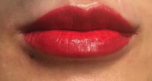 Before And After The Results Of Treatment And Sculpting Queen Lips For Women 5
