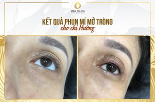 Before And After Eyelid Spraying For Female Clients 40