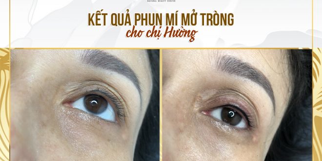 Before And After Eyelid Spraying For Female Clients 3