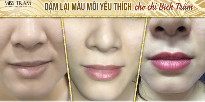Before And After The Queen's Lip Sculpting Results For Customers 4