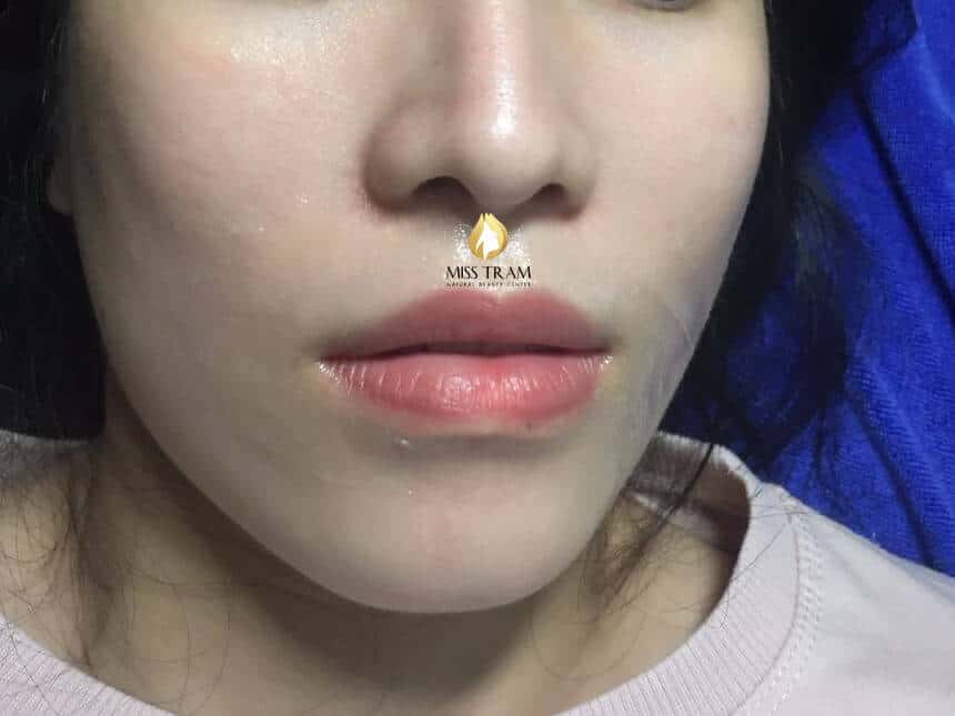 Before And After Queen Lip Sculpting Results For Women 6